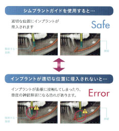 Simplant-Guide (シムプラントガイド)