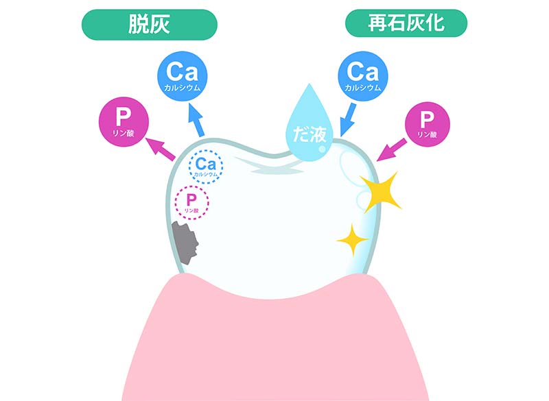 むし歯の原因とメカニズム
