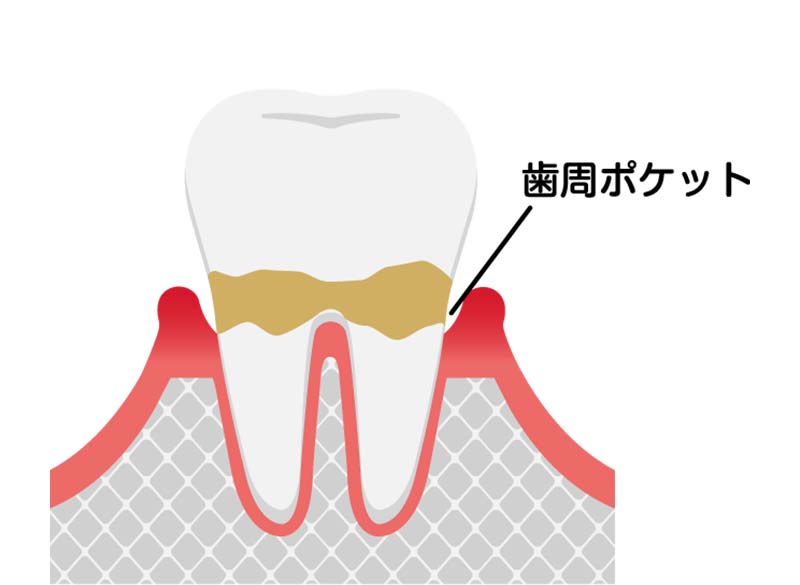 歯周炎（軽度）