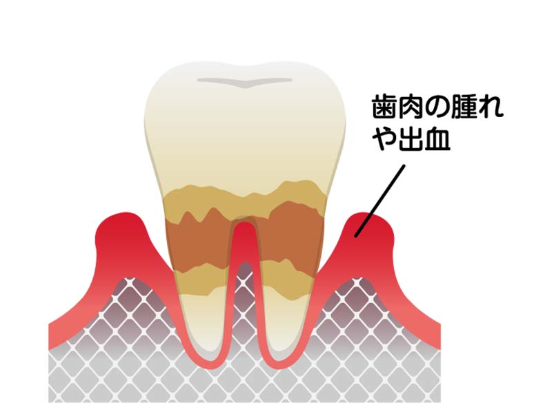 歯周炎（中度）