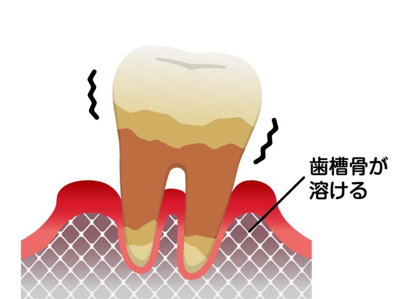 歯周炎（重度）